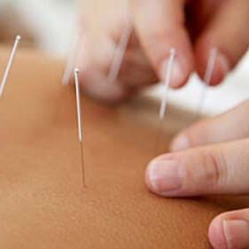 A person is using acupuncture needles on the back of their body.